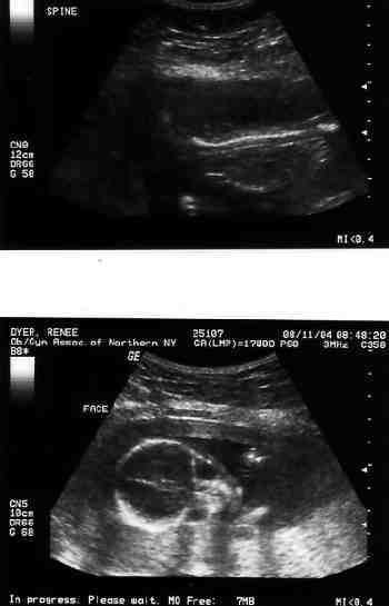 First Ultrasound, spine in top picture, face in bottom