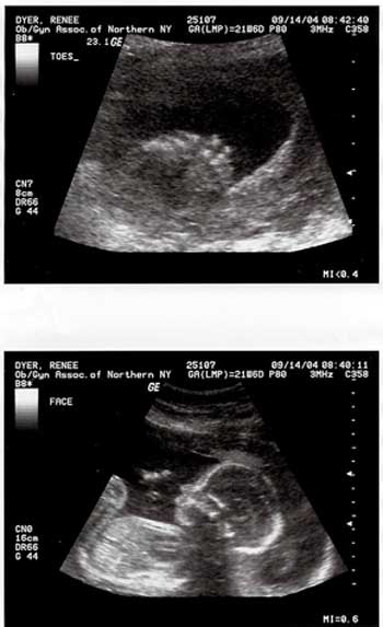 Ultrasound pictures showing feet and profile